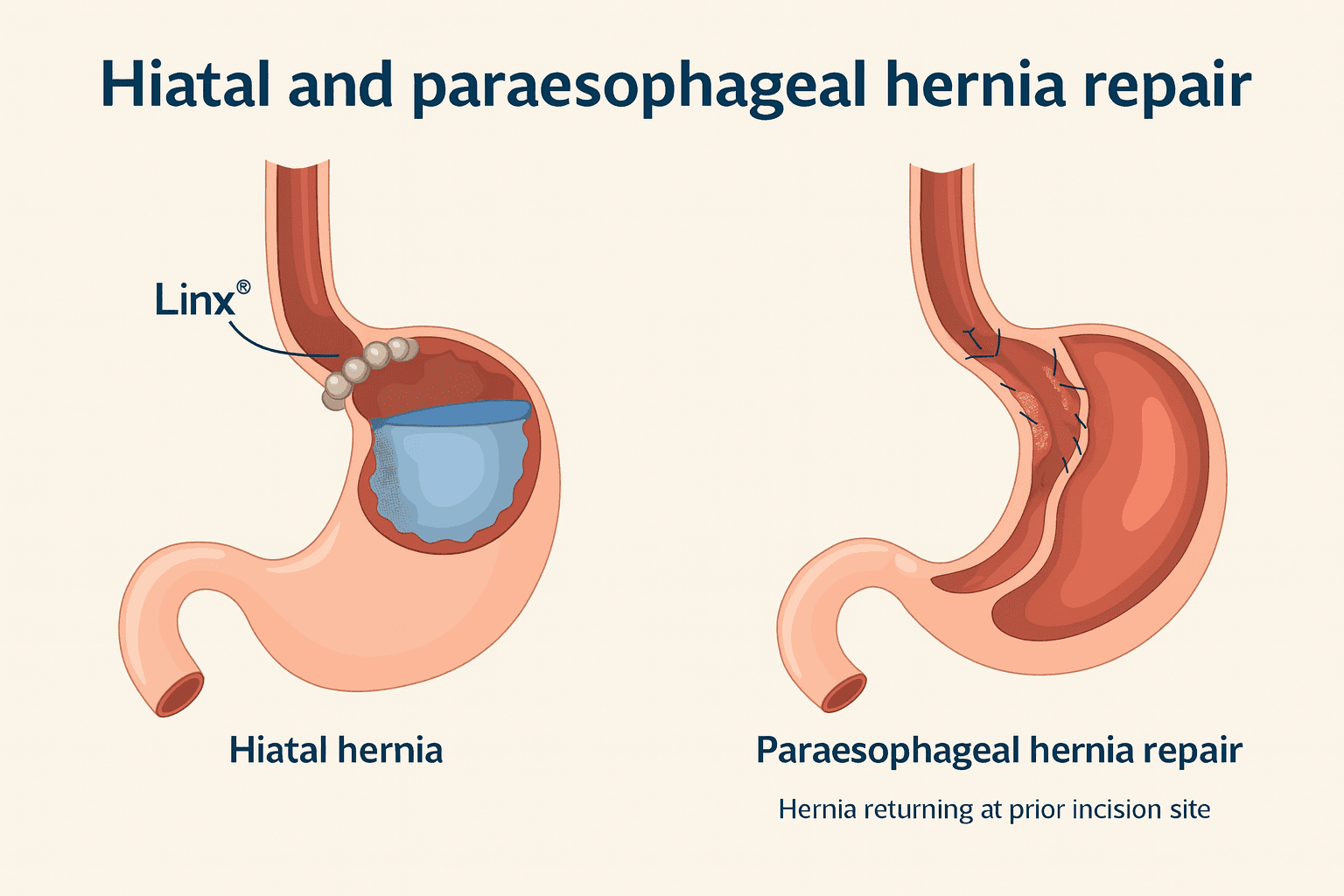 Gastroesophageal reflux disease (GERD)